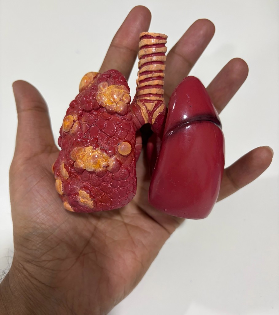 Model lungs showing healthy lung and diseased lung with the airway